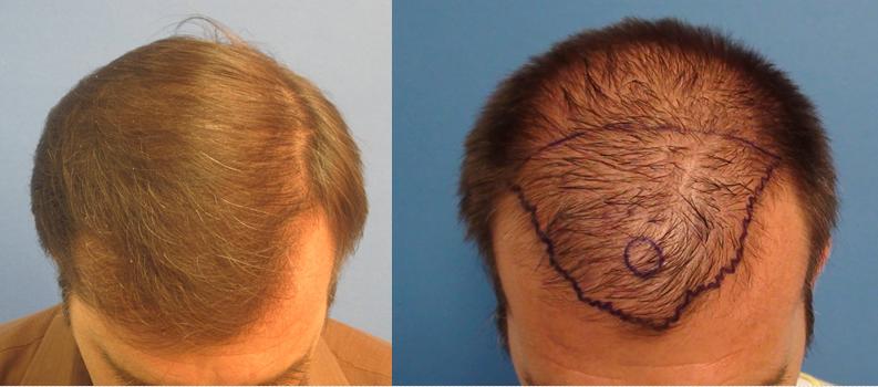 Mens Before and After Hair Transplant Photos