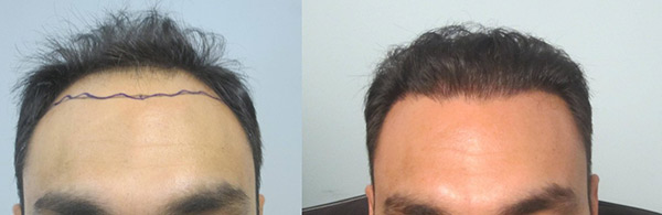 Mens Before and After Hair Transplant Photos