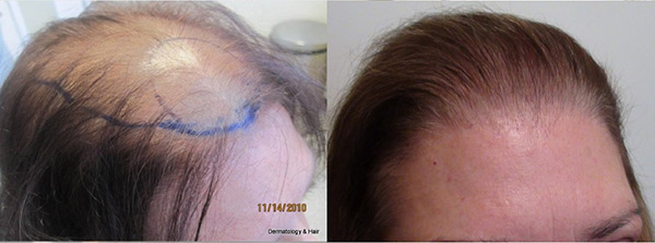 finasteride for hair loss before and after