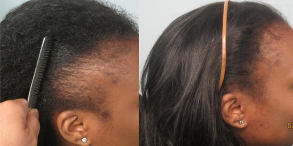 African American Hair Transplant