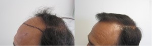 los angeles hair transplant 