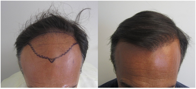 hair transplant los angeles