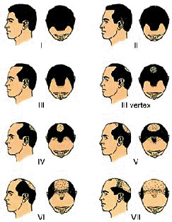 5 Categories of Hair Loss 