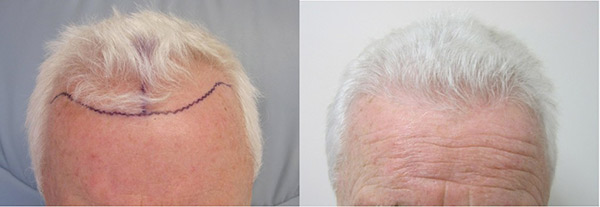 hair-transplant-los-angeles cost