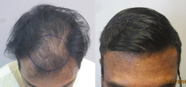 hair-transplant-LA