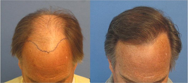 hair transplant los angeles