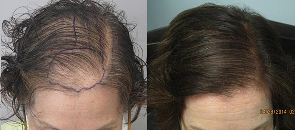 womens-hair-transplant-la3