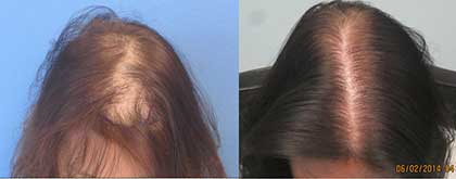 womens-hair-transplant