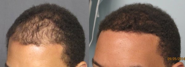 FUE hair transplant