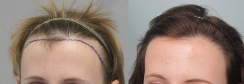 los angeles womens hair transplant