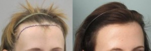 This young lady had 1,834 grafts placed in her hairline. This level of density and naturalness can be accomplished when performing hair transplant only on one person per day, which is Dr. Behnams philosophy.