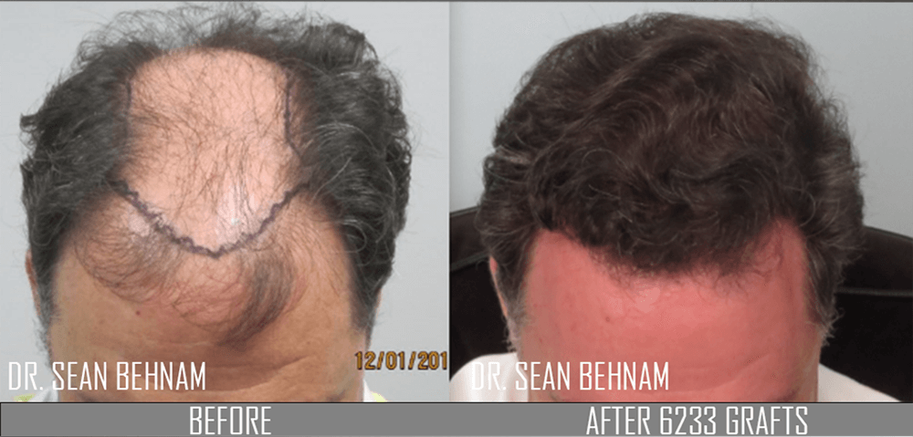 Hair transplant before and after