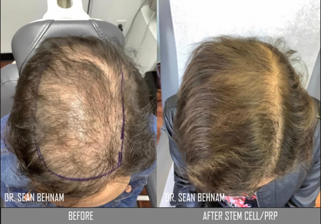 Man hair transplant before and after