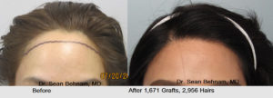 Woman hair transplant before and after